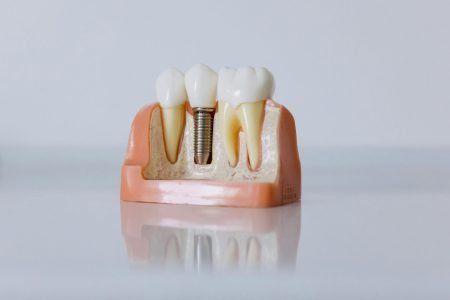 All-on-4 ir All-on-6 implantai